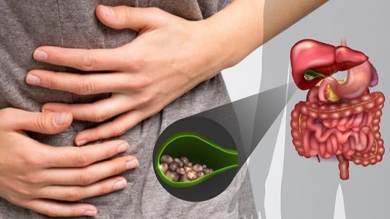 Một biến chứng muộn sau phẫu thuật cắt dạ dày là hình thành sỏi mật