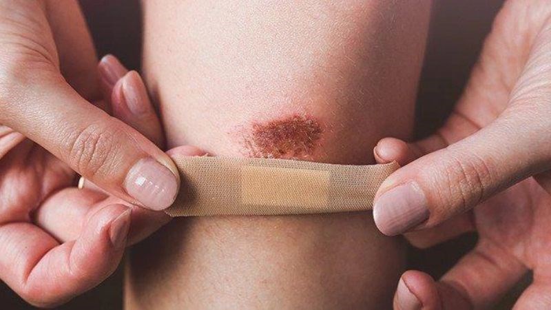 Hương nhu chứa các hợp chất kháng khuẩn, kháng viêm giúp vết thương mau lành
