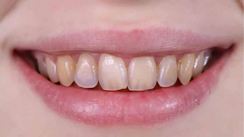 Hương nhu có thể làm hỏng men răng do chứa thủy ngân và axit