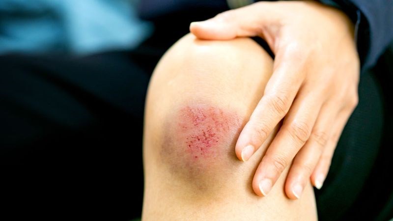 Hương nhu có thể ngăn chặn sự phát triển của vi khuẩn dẫn tới nhiễm trùng