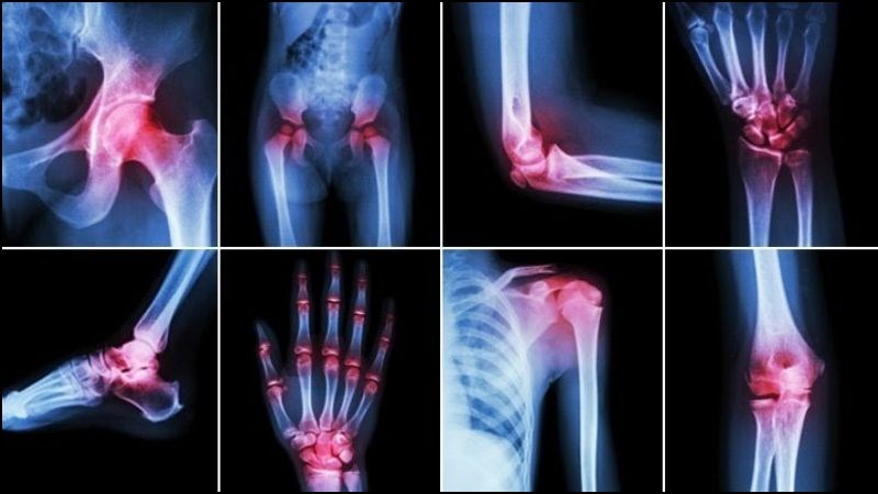 Bài thuốc chữa tê thấp, nhức mỏi gân xương từ kê huyết đằng