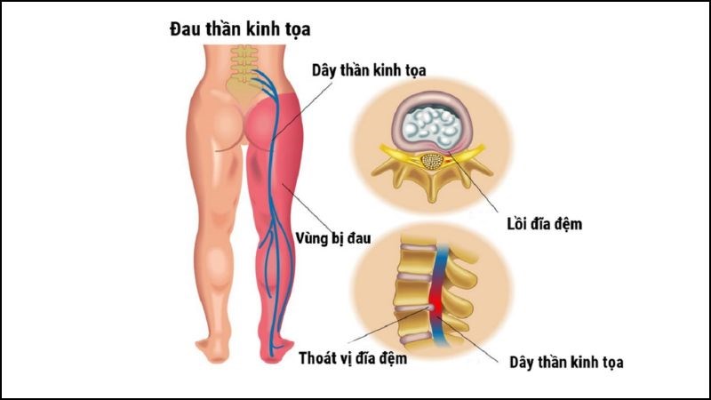 Bài thuốc chữa đau thần kinh tọa từ kê huyết đằng