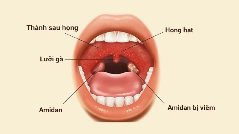 Rẻ quạt giúp chữa viêm họng hạt