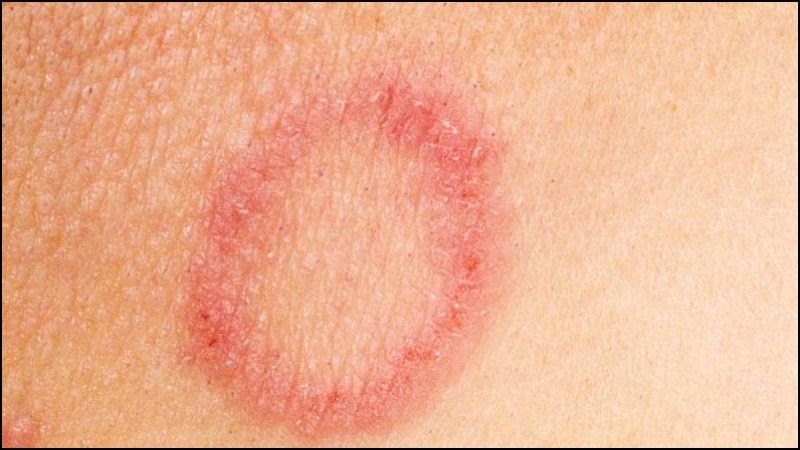 Rẻ quạt có khả năng chống nấm da và diệt vi khuẩn