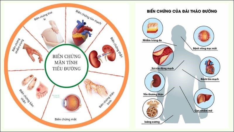 Trong dịch bệnh COVID-19, bệnh đái tháo đường dễ tiềm ẩn nhiều bệnh lý nguy hiểm