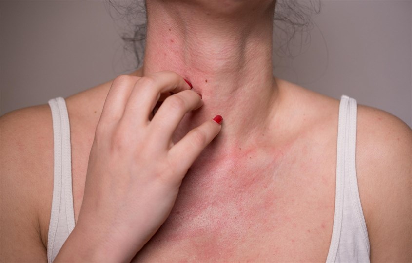 Chất tạo màu thực phẩm và dị ứng