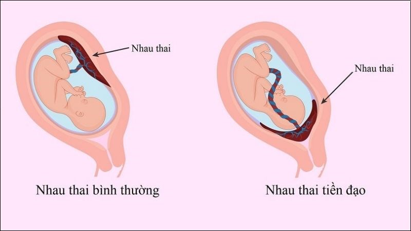 Nhau tiền đạo là nguyên nhân gây chảy máu ở tam cá nguyệt thứ 2,3