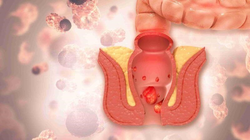 Chảy máu hậu môn không phải lúc đi đại tiện có thể là do bệnh trĩ