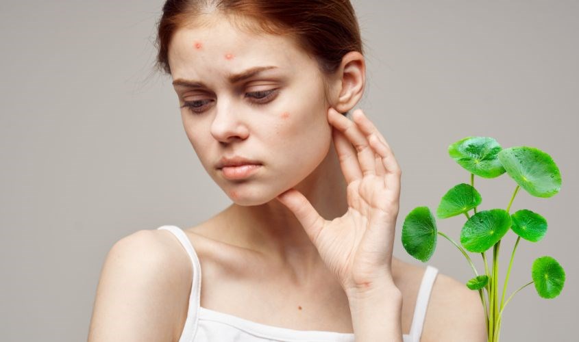 Chiết xuất rau má có khả năng kháng viêm, trị mụn hiệu quả