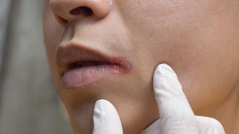 Chốc mép là tình trạng xuất hiện vùng da sưng, đỏ gây đau rát, ngứa hoặc mụn nước quanh khóe miệng 