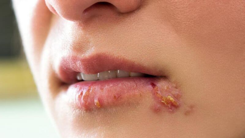 Xuất hiện mụn nước nhỏ li ti quanh khóe miệng là triệu chứng của chốc mép