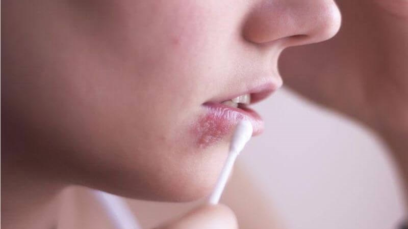 Sử dụng các thuốc bôi có thể giúp điều trị bệnh