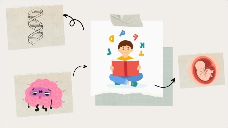 Nguyên nhân của chứng khó đọc là do di truyền, thần kinh, rối loạn phát triển não Nguyên nhân của chứng khó đọc là do di truyền, thần kinh, rối loạn phát triển não