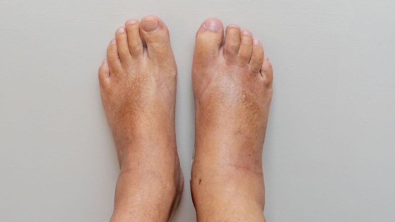 Chướng bụng kèm theo phù chân là dấu hiệu cần đến khám bác sĩ 