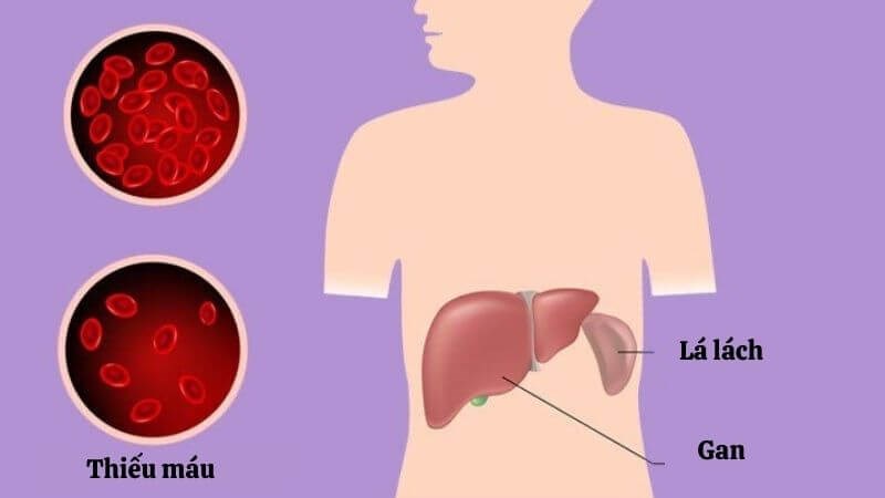 Cường lách là hiện tượng lá lách tăng hoạt động dẫn đến phá hủy sớm các tế bào máu