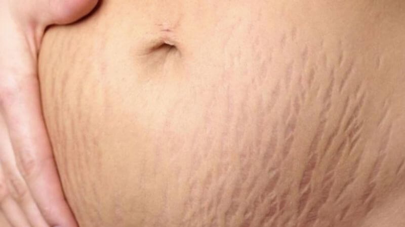 Vết rạn da màu đỏ tía là những đường vỡ da có màu đỏ khác biệt với những vùng xung quanh Vết rạn da màu đỏ tía là những đường vỡ da có màu đỏ khác biệt với những vùng xung quanh