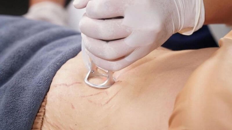 Kỹ thuật laser giúp điều trị rạn da màu đỏ tía hiệu quả Kỹ thuật laser giúp điều trị rạn da màu đỏ tía hiệu quả