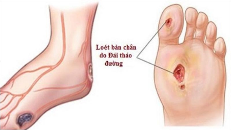 Vết thương hoặc vết loét lâu lành là triệu chứng khác khi bị đái tháo đường