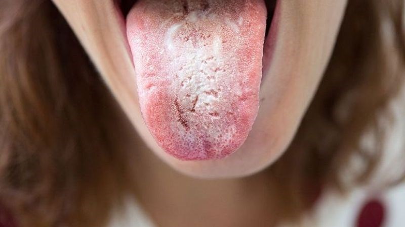 Hội chứng bỏng rát miệng làm tổn thương dây thần kinh vị giác gây đắng miệng