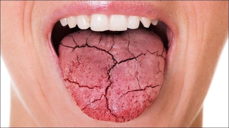 Khi lưỡi hay niêm mạc miệng bị khô sẽ dẫn đến tình trạng đắng miệng
