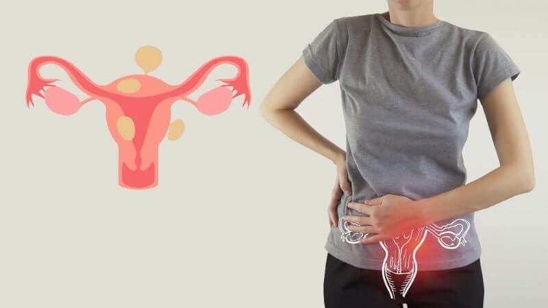 Phụ nữ đau bụng dưới có thể do u xơ tử cung