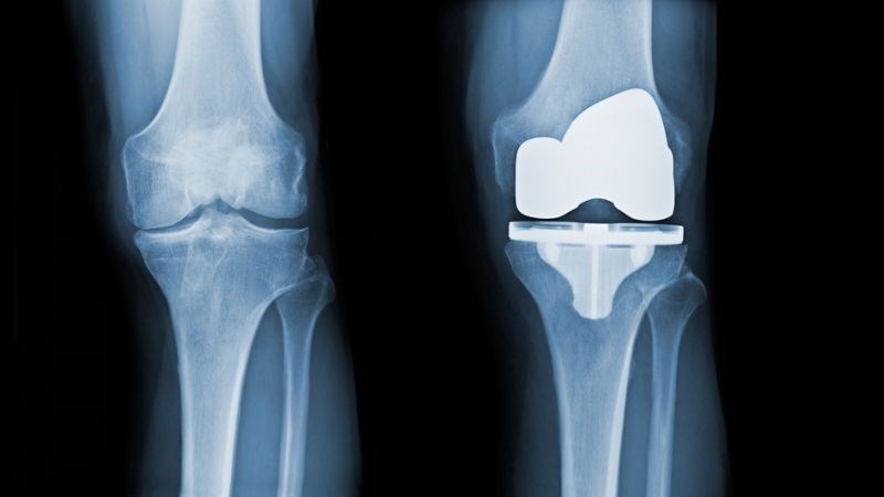 Phẫu thuật thay khớp gối Phẫu thuật thay khớp gối