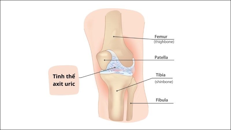 Gout tại khớp gối Gout tại khớp gối