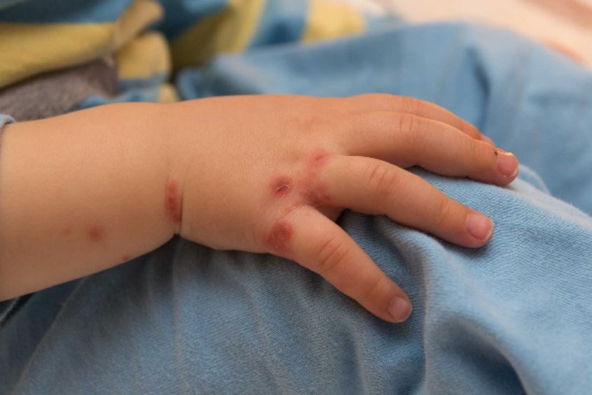 Dấu hiệu ghẻ nước ở trẻ