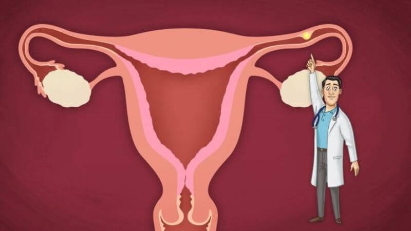 Mang thai ngoài tử cung là hiện tượng hợp tử không làm tổ bên trong buồng tử cung