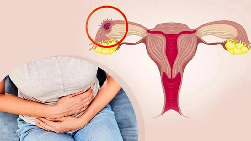 Mang thai ngoài tử cung có thể gây ra đau bụng dưới âm ỉ