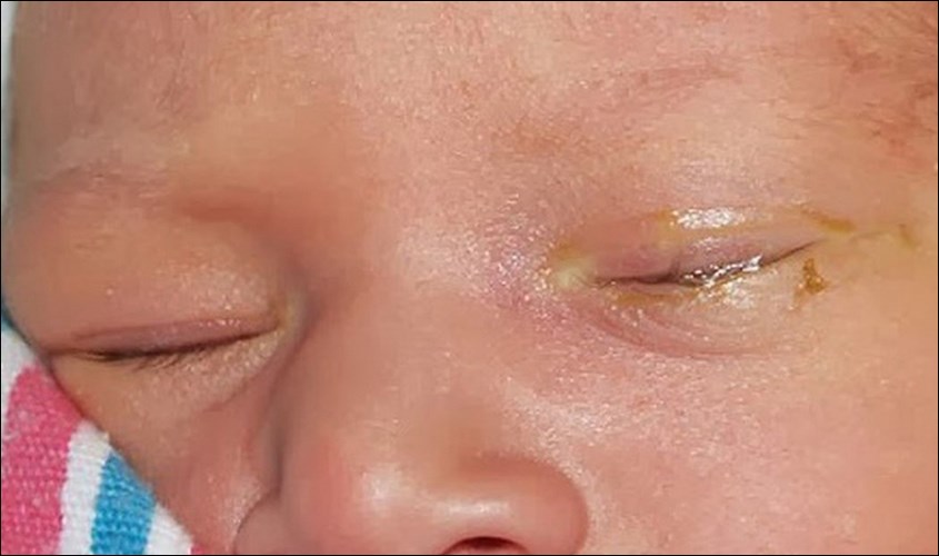 những dấu hiệu tắt tuyến lệ ở trẻ em