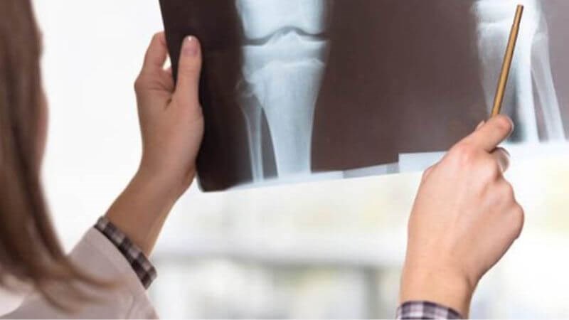 X-quang xương khớp có thể giúp bác sĩ chẩn đoán nguyên nhân gây đau khớp