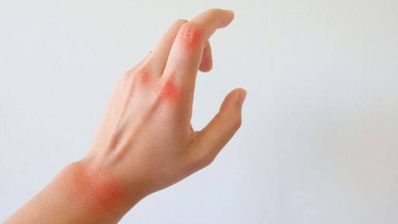 Đau nhiều khớp ngón tay là dấu hiệu cần đến gặp bác sĩ sớm