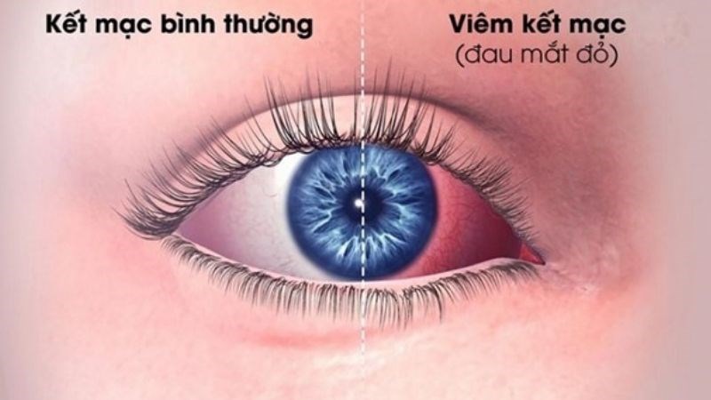 Đau mắt đỏ là một trong những bệnh nhiễm trùng mắt phổ biến nhất