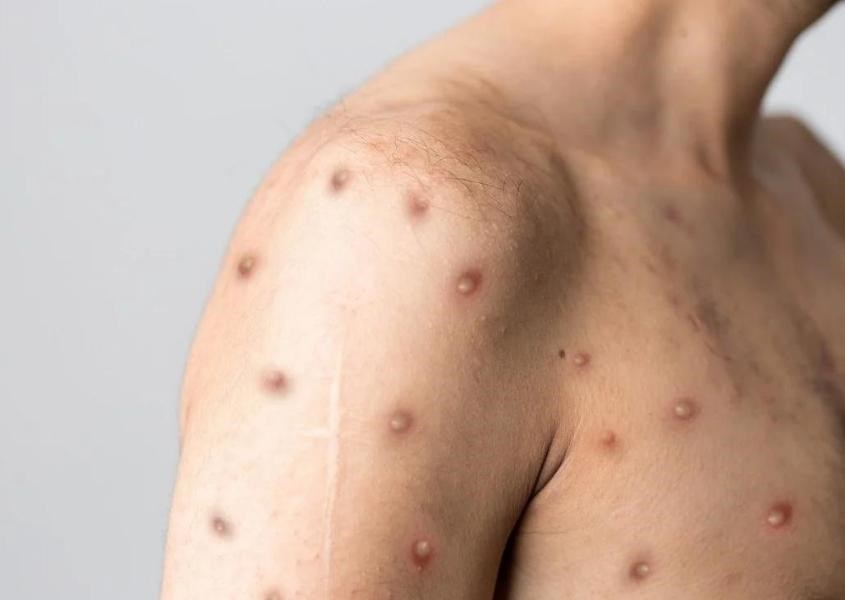 Tình trạng phát ban sẽ bắt đầu phát triển từ 1-5 ngày  sau khi có các triệu chứng đầu tiên. Nguồn từ News-Medical