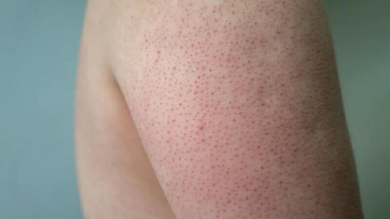 Dày sừng nang lông là tình trạng các nang lông xuất hiện nhiều lớp sừng hóa, nổi gồ trên bề mặt da