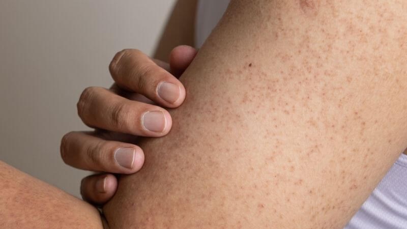 Dày sừng nang lông có thể gây ngứa ngáy, khó chịu