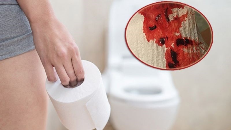 Đi ngoài ra máu là dấu hiệu cảnh báo của một số bệnh lý nghiêm trọng