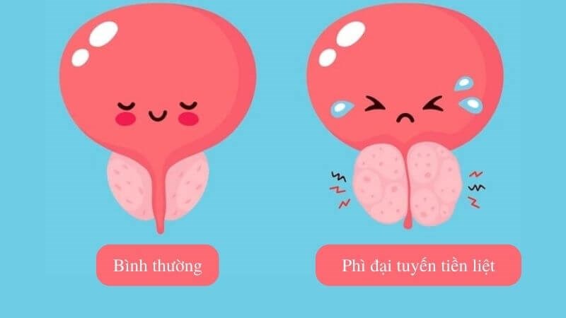 Phì đại tuyến tiền liệt là nguyên nhân gây đi tiểu nhiều lần phổ biến