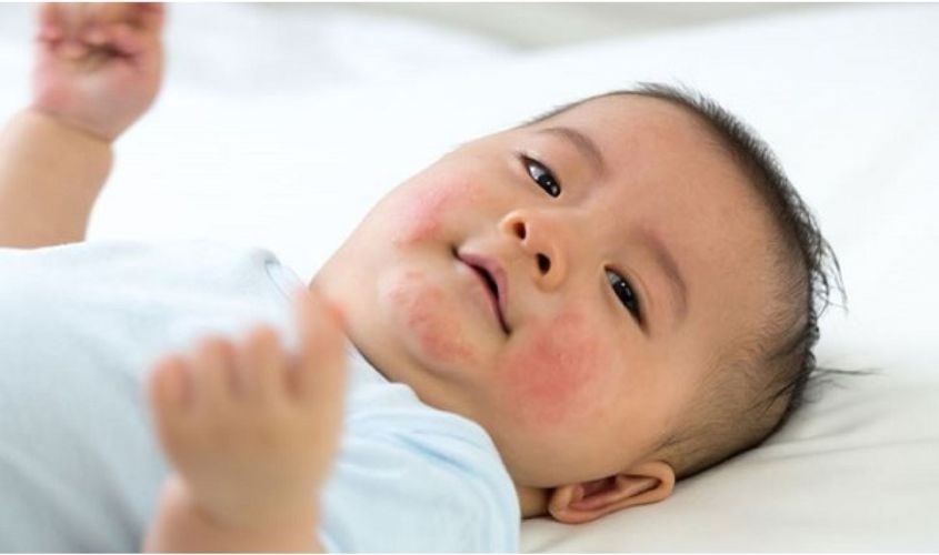 Trẻ bị dị ứng đạm sữa bò Trẻ bị dị ứng đạm sữa bò