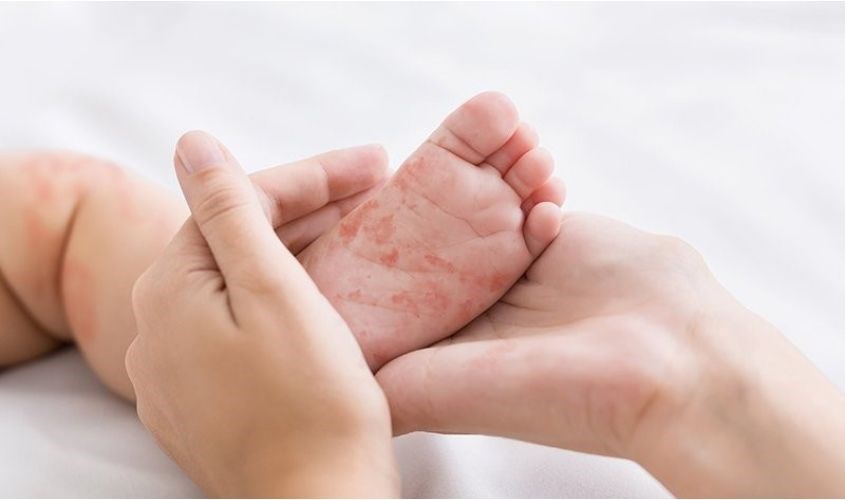 Trẻ bị nổi ban, mẩn ngứa Trẻ bị nổi ban, mẩn ngứa do dị ứng đạm sữa bò