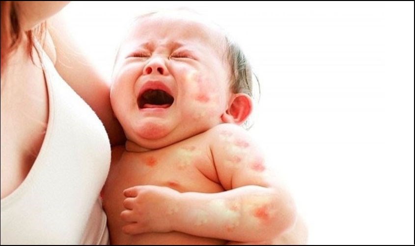 Trẻ quấy khóc, phát ban khắp người Trẻ quấy khóc, phát ban khắp người