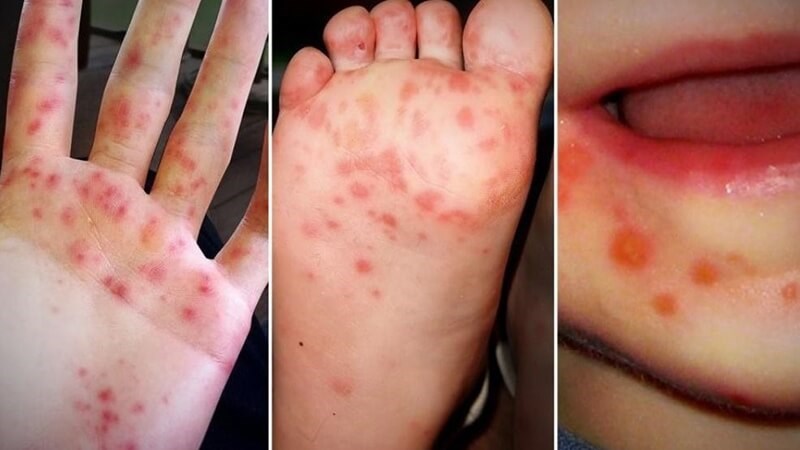 Tay chân miệng là bệnh nhiễm trùng do virus gây sốt, phát ban chủ yếu ở trẻ nhỏ