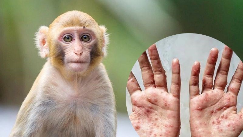 Bệnh đậu mùa khỉ  lần đầu được phát hiện trên đàn khỉ được nuôi để làm thí nghiệm