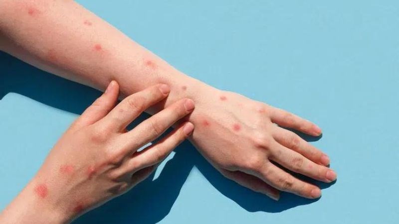 Triệu chứng điển hình của bệnh là các nốt tổn thương ở da