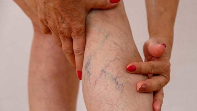 Xuất hiện các mạch máu màu xanh tím trên chân là dấu hiệu của bệnh