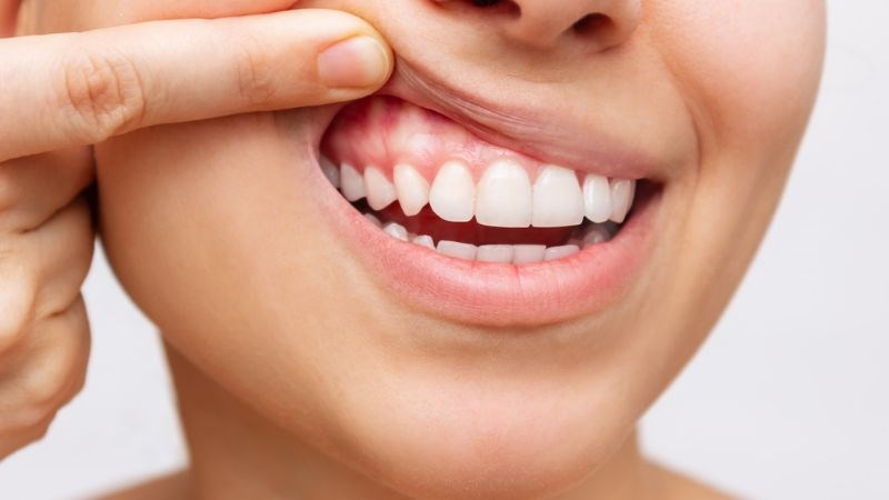 Hạt sen chứa sắt, chất sơ mang nhiều lợi ích cho sức khỏe răng, nướu