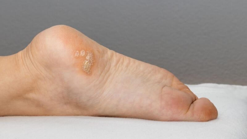 Mụn cóc lòng bàn chân