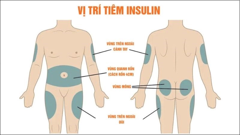 Có thể tiêm insulin ở vị trí mô mỡ ngay dưới da