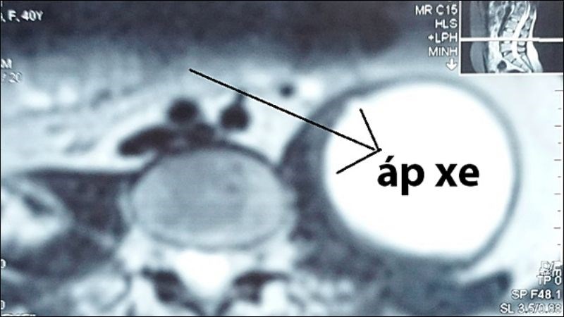 Tình trạng viêm, áp xe trở nặng và gây chèn ép thần kinh xung quanh đốt sống Tình trạng viêm, áp xe trở nặng và gây chèn ép thần kinh xung quanh đốt sống
